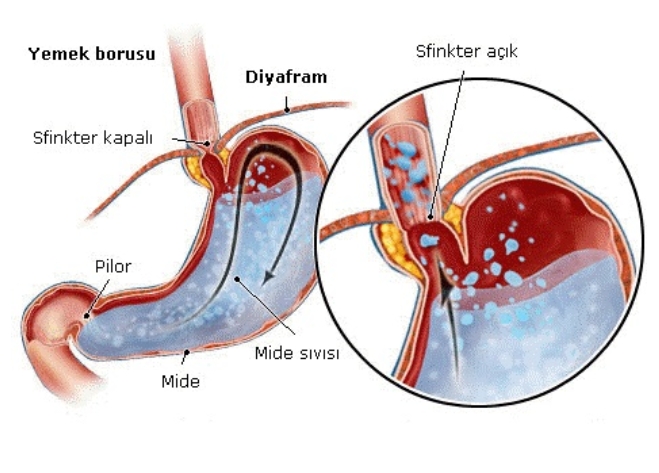 Mide Yanması ve Reflüyü Doğal Yollar ile Tedavi Edin! galerisi resim 2