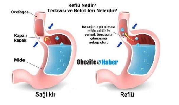 Mide Yanması ve Reflüyü Doğal Yollar ile Tedavi Edin! galerisi resim 3