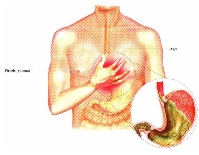 Mide Yanması ve Reflüyü Doğal Yollar ile Tedavi Edin! galerisi resim 5