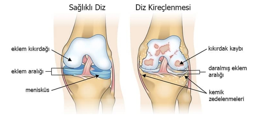 Diz Ağrıları için galerisi resim 2